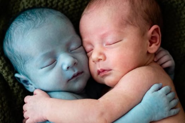 When the nurse placed the lifeless baby beside her healthy twin, she only hoped to say goodbye